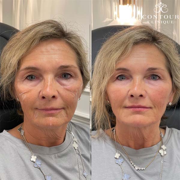 B&A 2