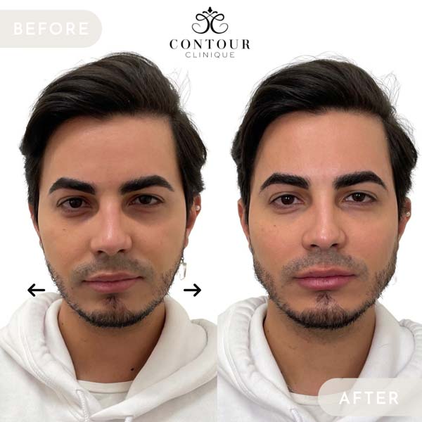 B&A 6