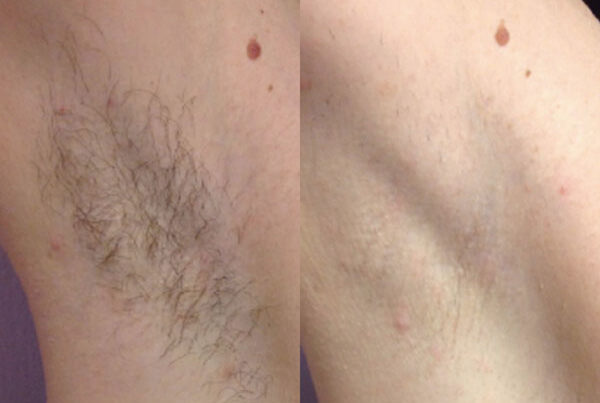 Underarm laser hair removal before and after on light skin showing reduced hair growth and smoother skin.