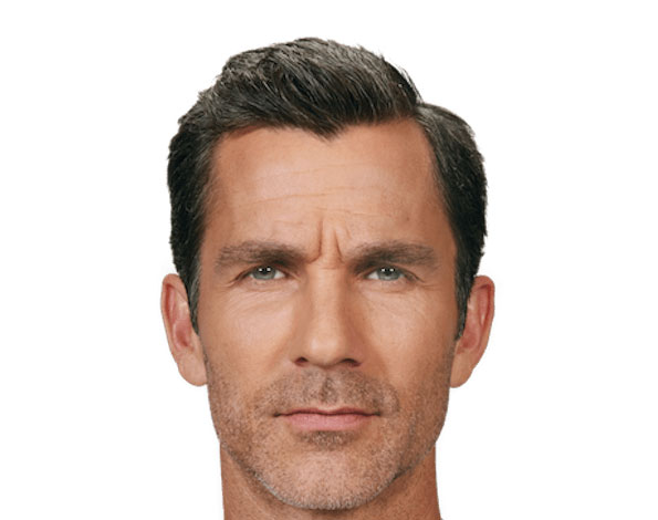 A before photo of a man with crease between his eyebrows before Botox in Tampa.