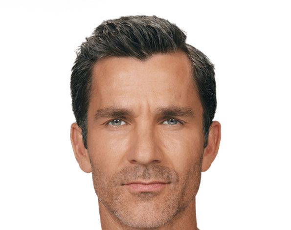 A man after Botox in Tampa with less wrinkles.