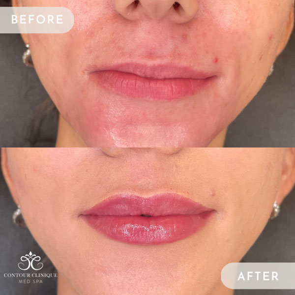 Lip-Pump-22 Lip-Pump-22