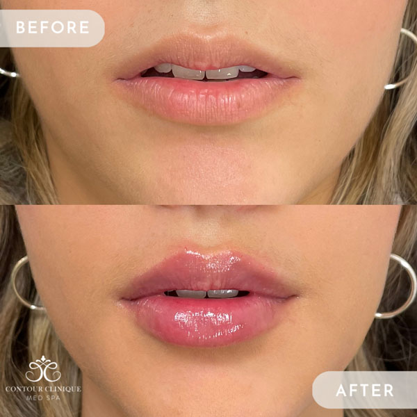 Lip-Pump-31