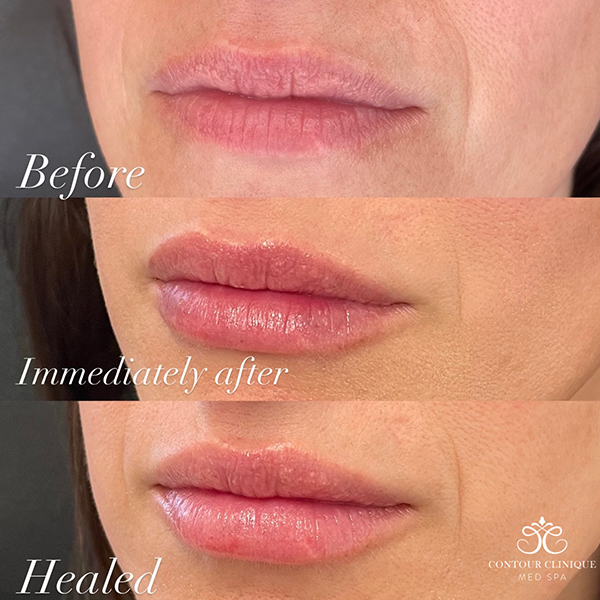 Lip-Pump-43