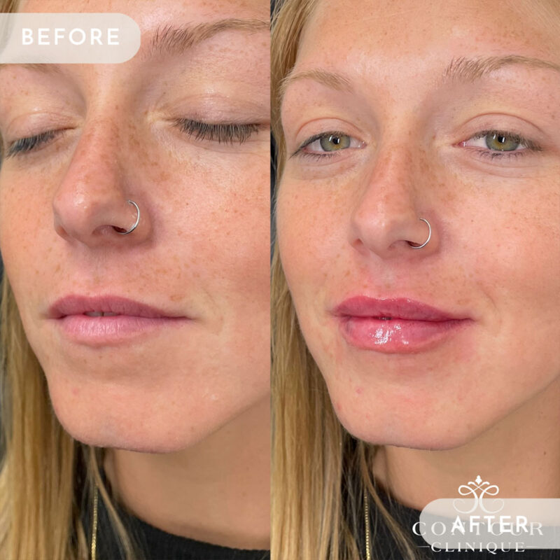 lip-pump-45e