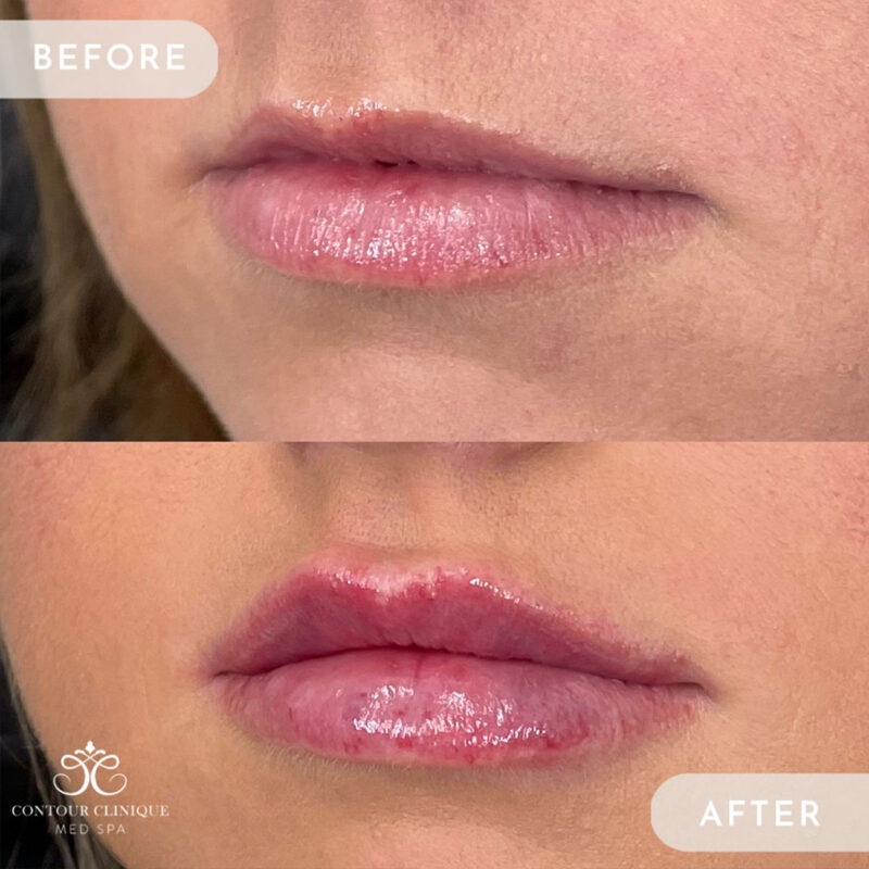 lip-pump-46e
